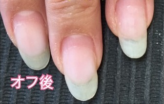 自爪に優しいフィルイン専門