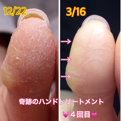 奇跡のハンドトリートメント